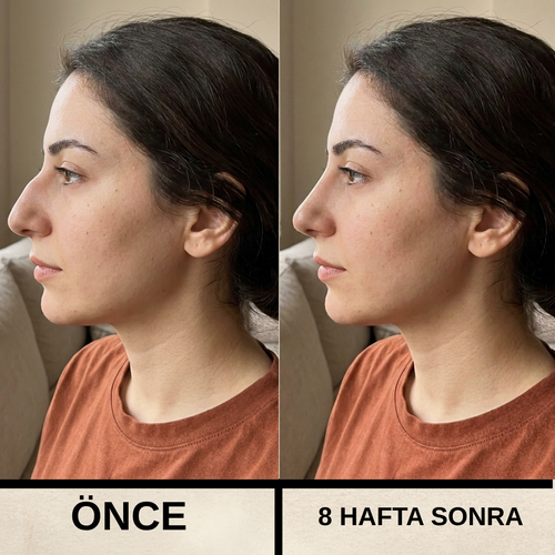 Formella Burun Şekillendirme Cihazı