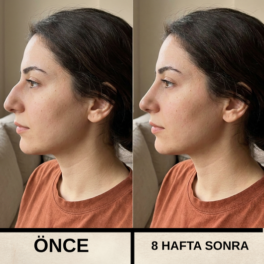 Formella Burun Şekillendirme Cihazı